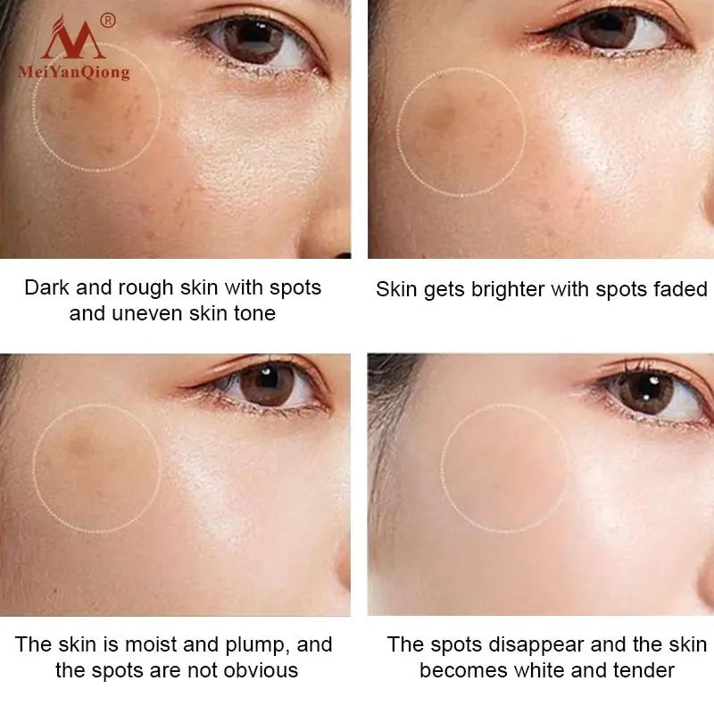 👩 Powerful Whitening Freckle Cream Remove Whitening Freckle Cream Plant Face Cream Remove Freckles and Dark Spots